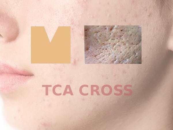 TCA-CROSS пилинг