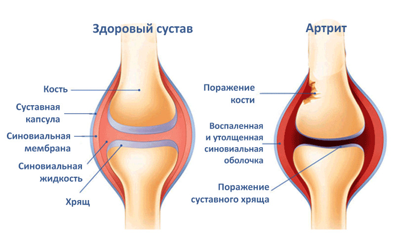 Лечение артроза