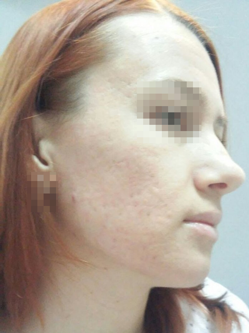 Фракционная СО2 шлифовка: 10 день
