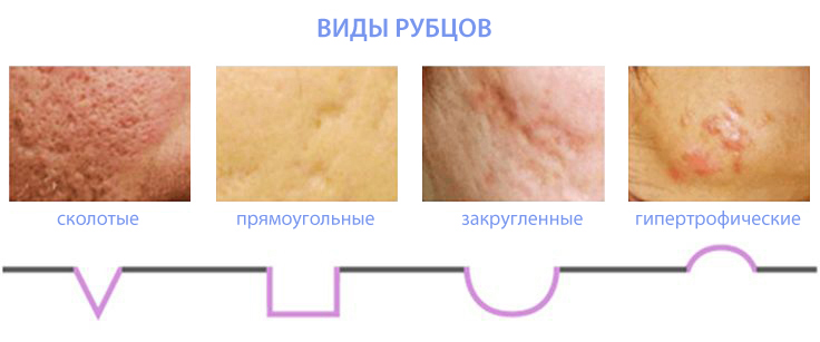 Субцизия рубцов постакне